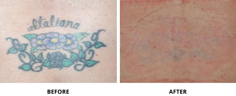 laser_tattoo_removal_before_and_after_3
