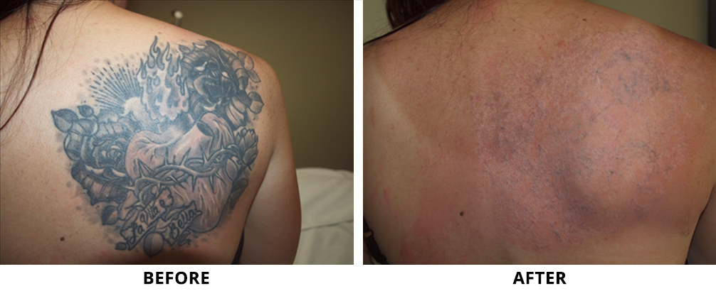 laser_tattoo_removal_before_and_after_2