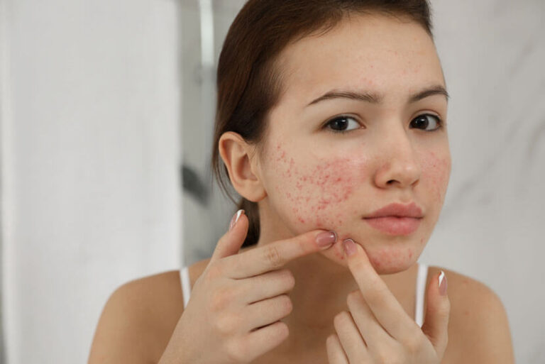 Acne Treatment