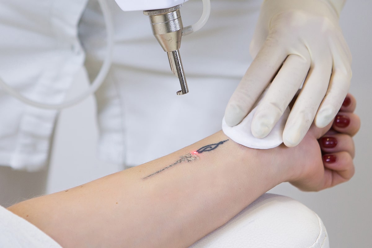 Laser Tattoo Removal | PicoSure Laser Tattoo Removal, Scar Treatment