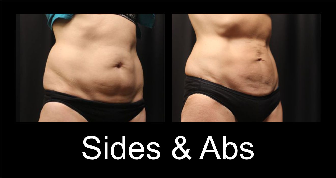 Sides_Abs