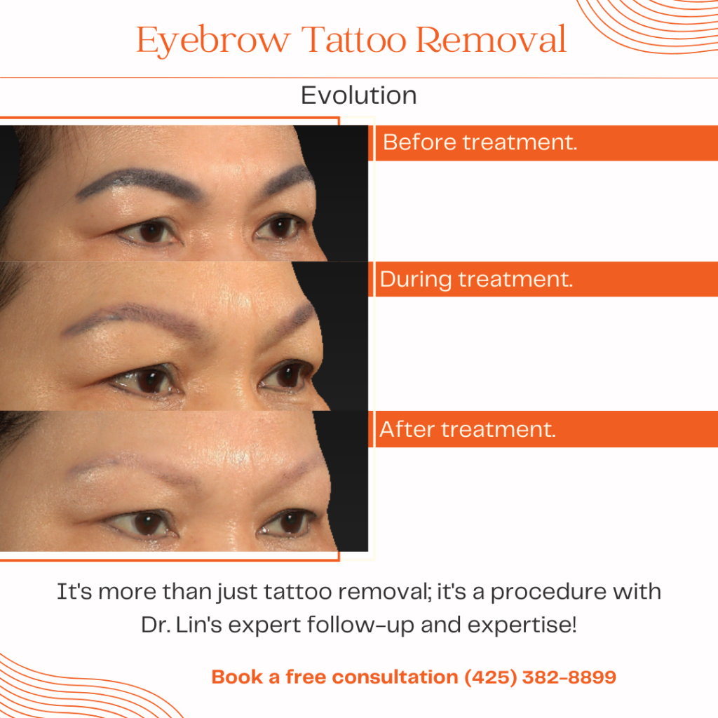 laser_tattoo_removal_eyebrow_tattoo_removal