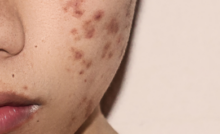 "A young Asian woman with acne on half of her face."