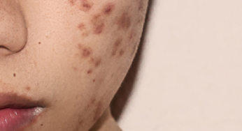 Does Acne Affect You?