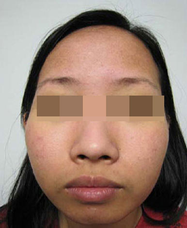 Before and after acne treatment at Mill Creek Skin & Laser. Individual results may vary. Before and after acne treatment at Mill Creek Skin & Laser. Individual results may vary.