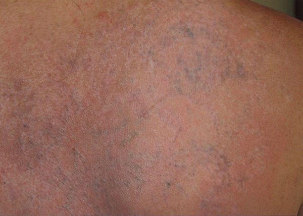 Move slider to see before and after images. Individual results may vary. Before and after images of tattoo removal at Mill Creek Skin & Laser. Individual results may vary.