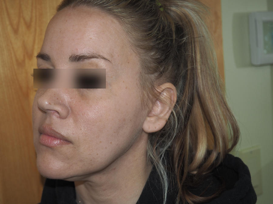 Before and after images of Botox treatment at Mill Creek Skin & Laser. Before and after images of Botox treatment at Mill Creek Skin & Laser.