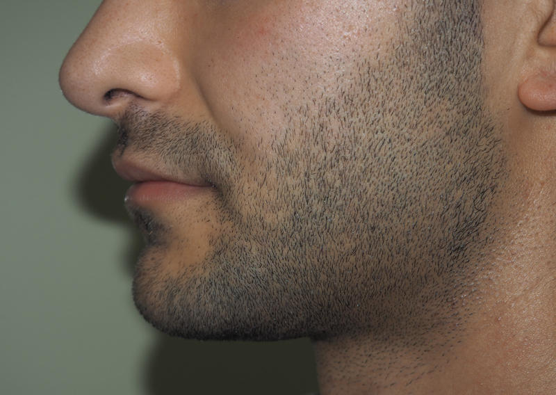 Before and after images of kybella treatment at Mill Creek Skin & Laser. Individual results may vary. Before and after images of kybella treatment at Mill Creek Skin & Laser. Individual results may vary.