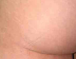 Before and after image of stretch mark treatment at Mill Creek Skin & Laser. Before and after image of stretch mark treatment at Mill Creek Skin & Laser.