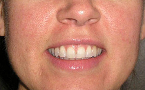 Before and after redness laser treatment at Mill Creek Skin & Laser. Before and after redness laser treatment at Mill Creek Skin & Laser.