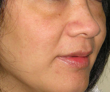 Before and after images of sun spot treatment at Mill Creek Skin & Laser. Before and after images of sun spot treatment at Mill Creek Skin & Laser.