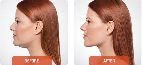 Before and after images of Kybella double chin injection treatment. Before and after images of Kybella double chin injection treatment.