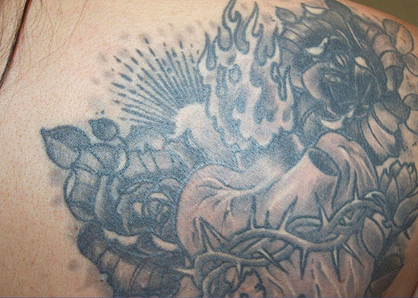 Move slider to see before and after images. Individual results may vary. Before and after images of tattoo removal at Mill Creek Skin & Laser. Individual results may vary.