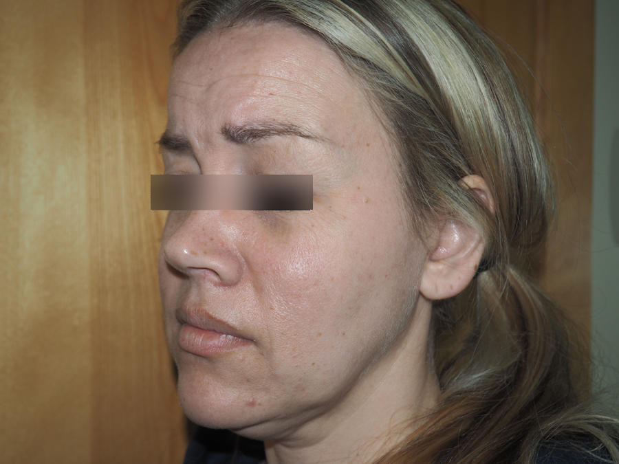 Before and after images of Botox treatment at Mill Creek Skin & Laser. Before and after images of Botox treatment at Mill Creek Skin & Laser.