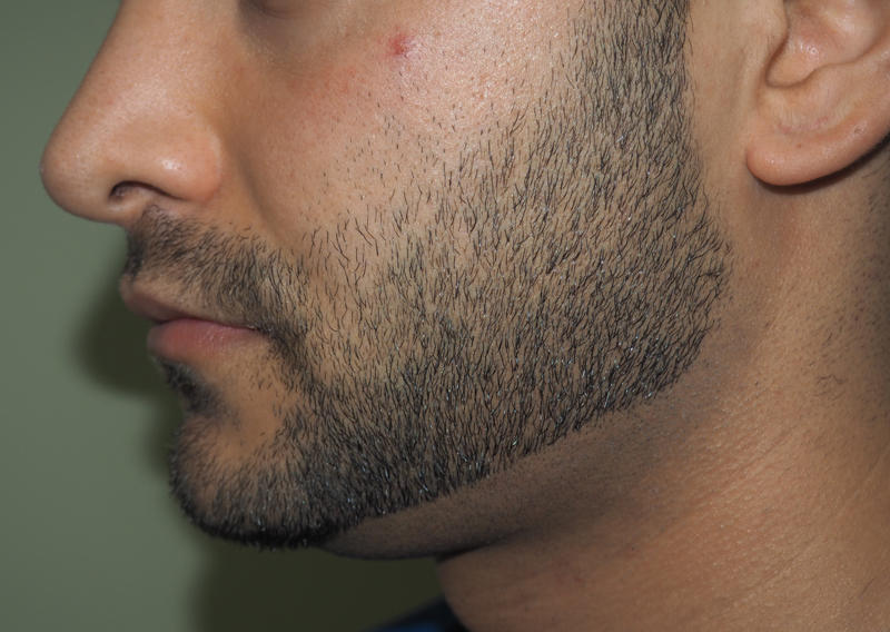 Before and after images of kybella treatment at Mill Creek Skin & Laser. Individual results may vary. Before and after images of kybella treatment at Mill Creek Skin & Laser. Individual results may vary.