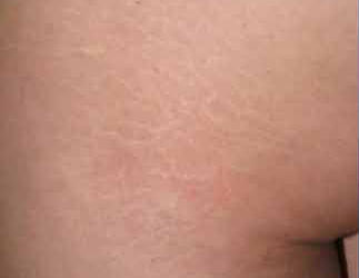 Before and after image of stretch mark treatment at Mill Creek Skin & Laser. Before and after image of stretch mark treatment at Mill Creek Skin & Laser.