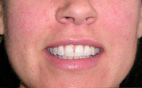 Before and after redness laser treatment at Mill Creek Skin & Laser. Before and after redness laser treatment at Mill Creek Skin & Laser.