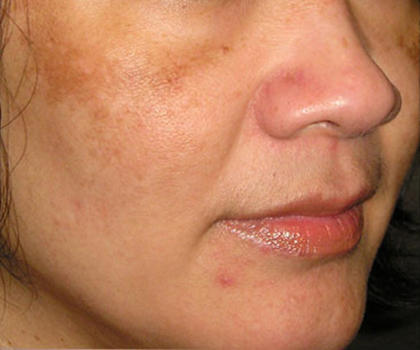 Before and after images of sun spot treatment at Mill Creek Skin & Laser. Before and after images of sun spot treatment at Mill Creek Skin & Laser.