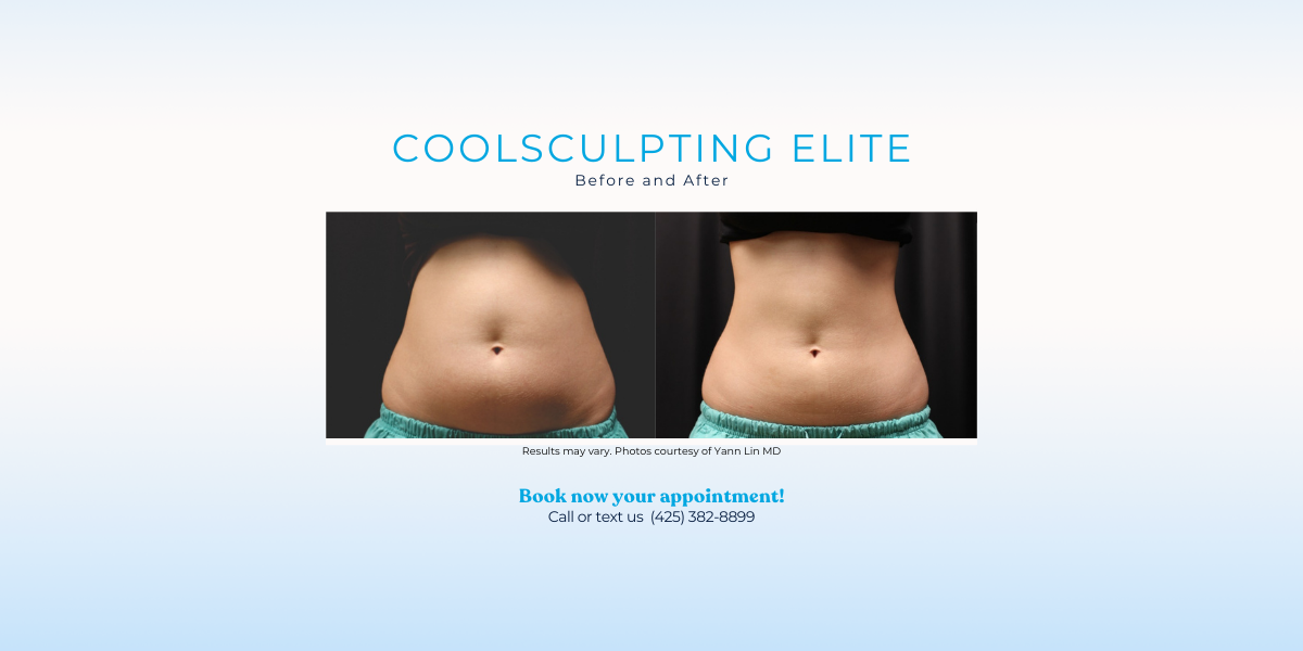 coolsculpting elite abs before and after pictures