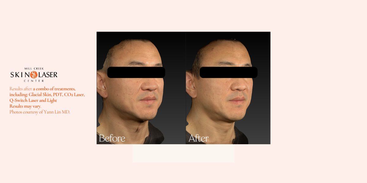 dr lin treatment combo before and after pictures