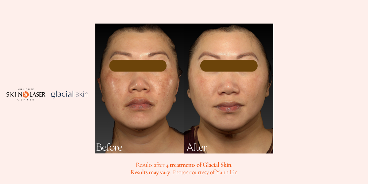 glacial skin before and after