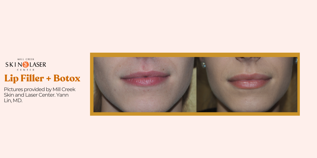 lipfiller berfore and after pictures