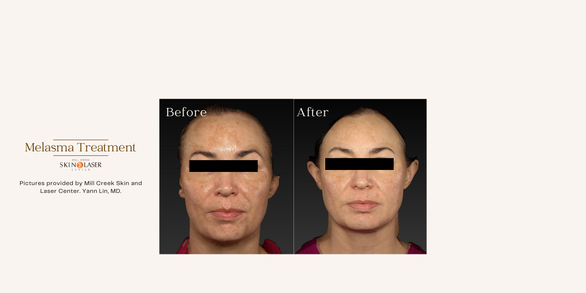 melasma treatment before and after pictures