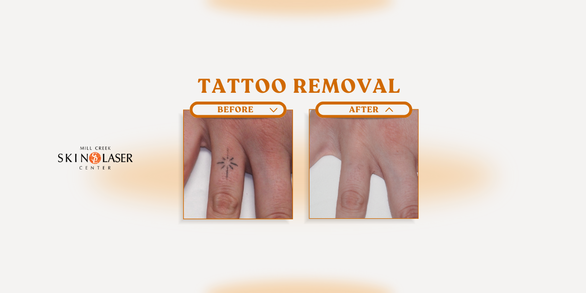 tattoo removal before and after pictures