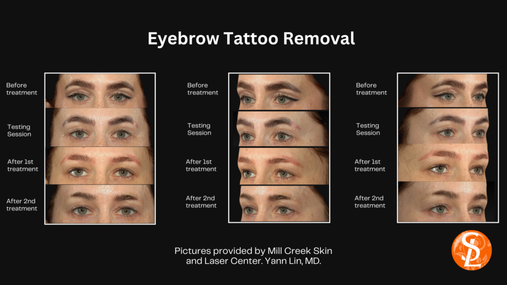 evolution-of-tattoo-removal-microblading