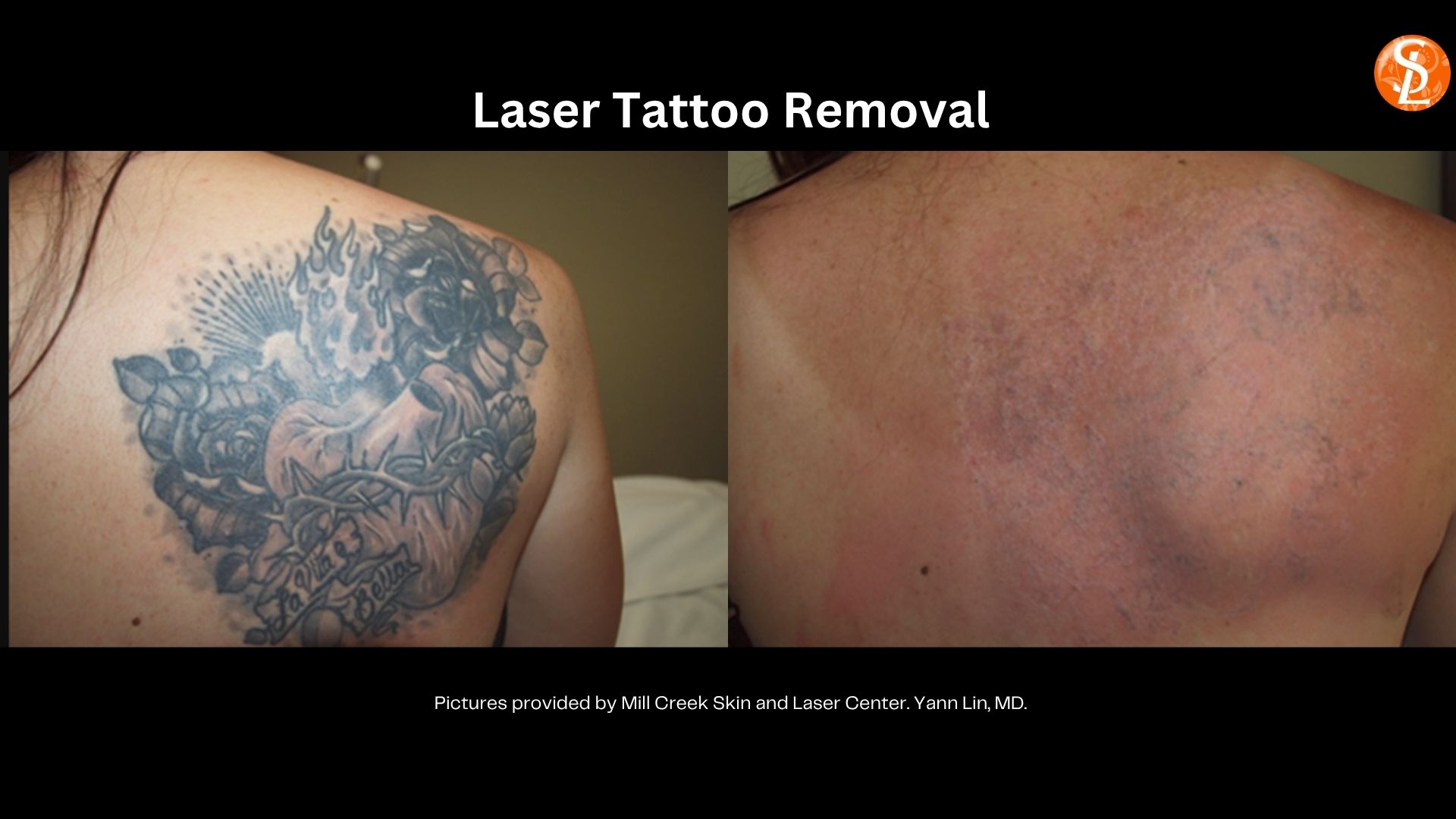 tattoo removal before and after