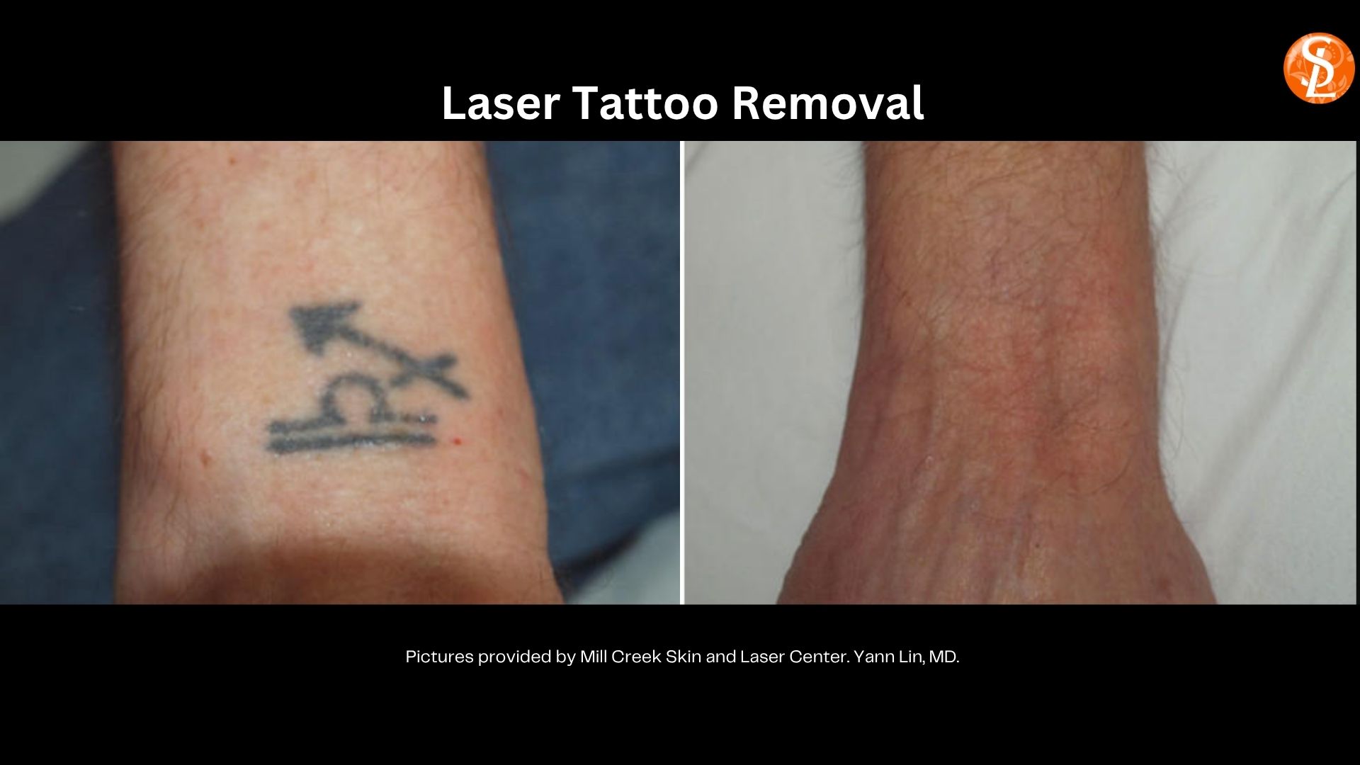 tattoo removal before and after