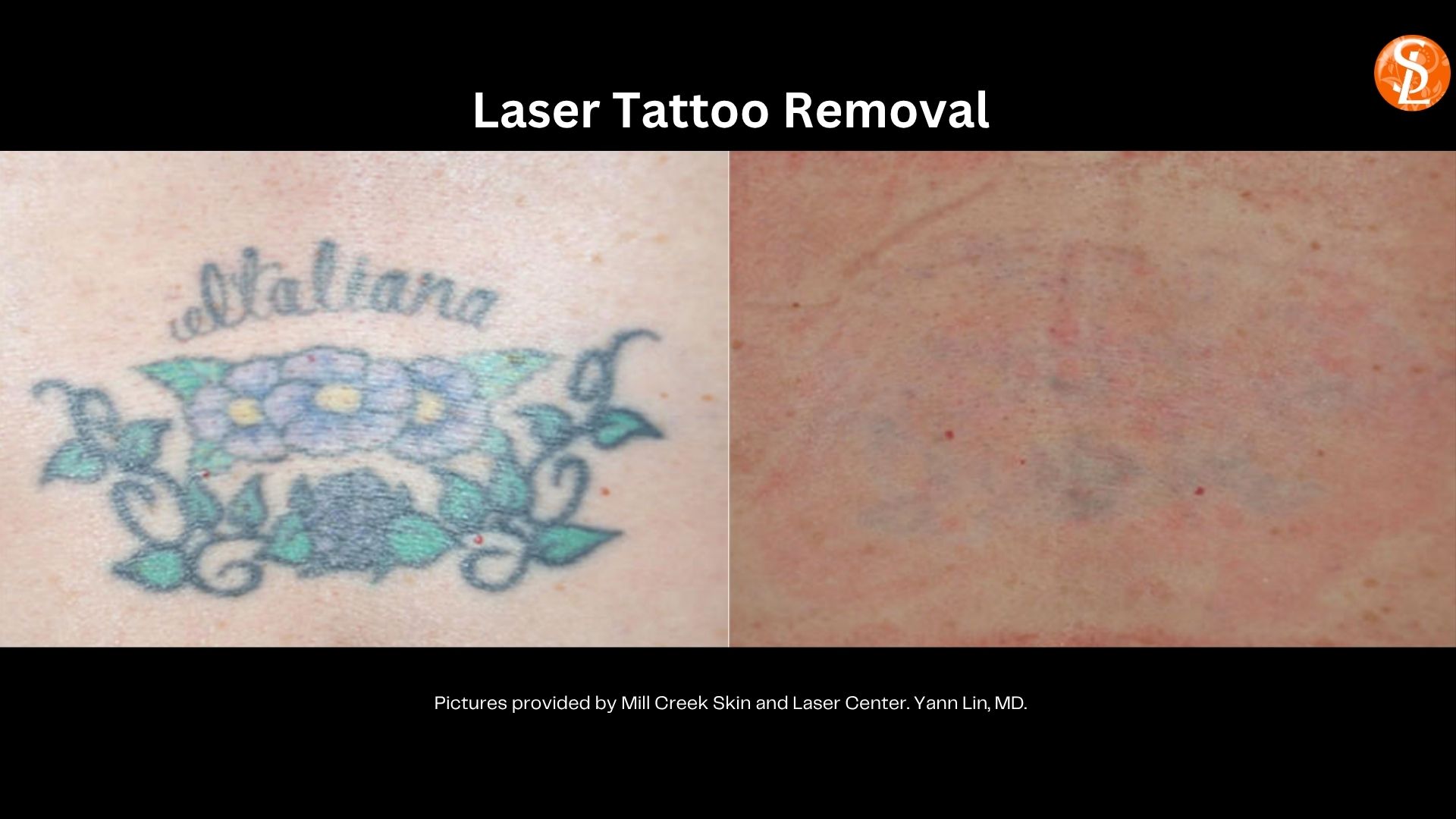 tattoo removal before and after